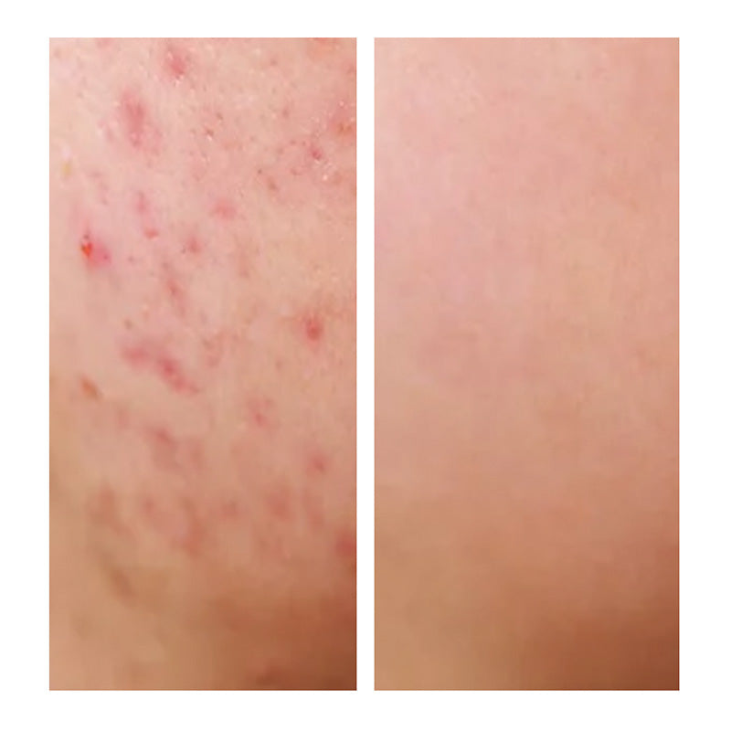 Acne Management Royal Labs Natural Cosmetics, Inc.