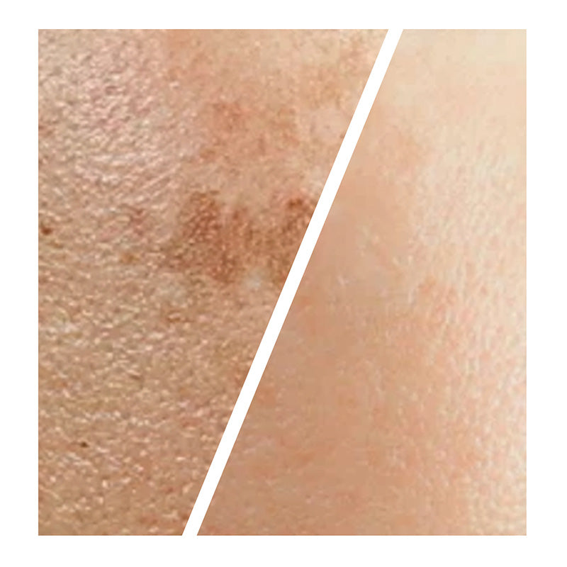 Hyperpigmentation Reduction